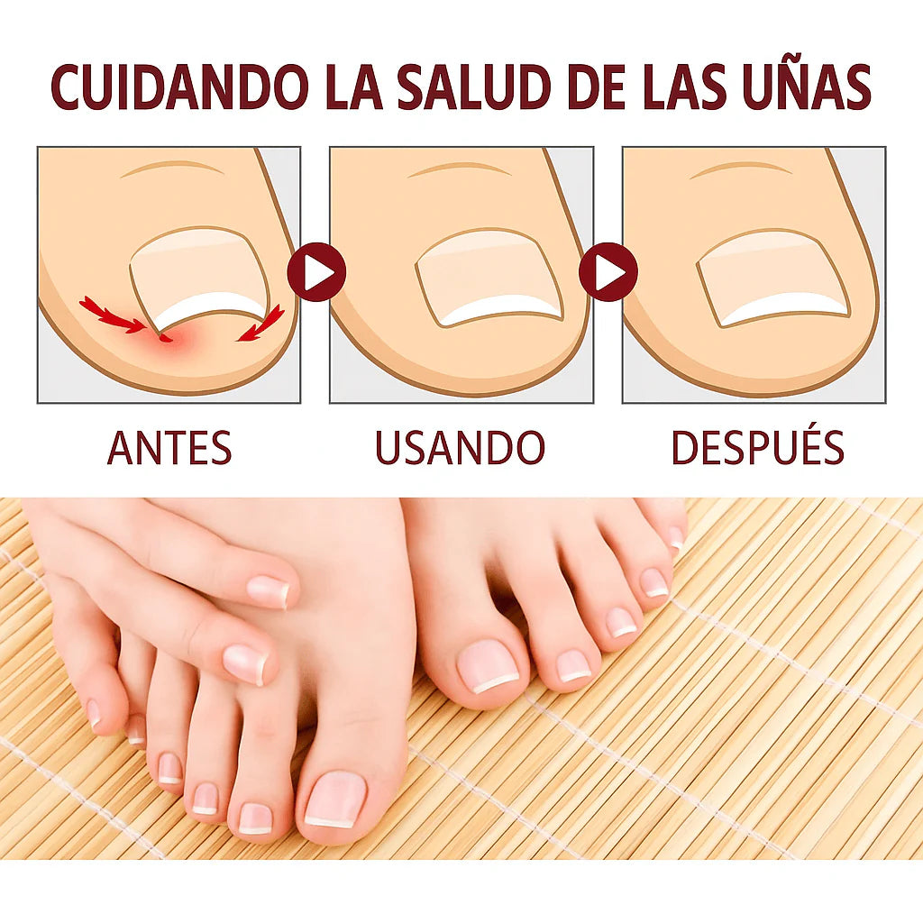 Aceite Anti‑Hongos para Uñas – Recupera el brillo y elimina la infección naturalmente 2x1