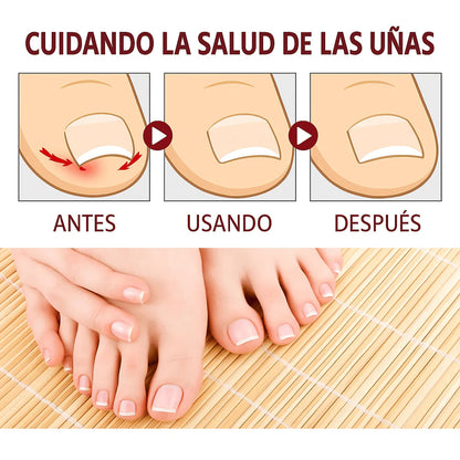 Aceite Anti‑Hongos para Uñas – Recupera el brillo y elimina la infección naturalmente 2x1